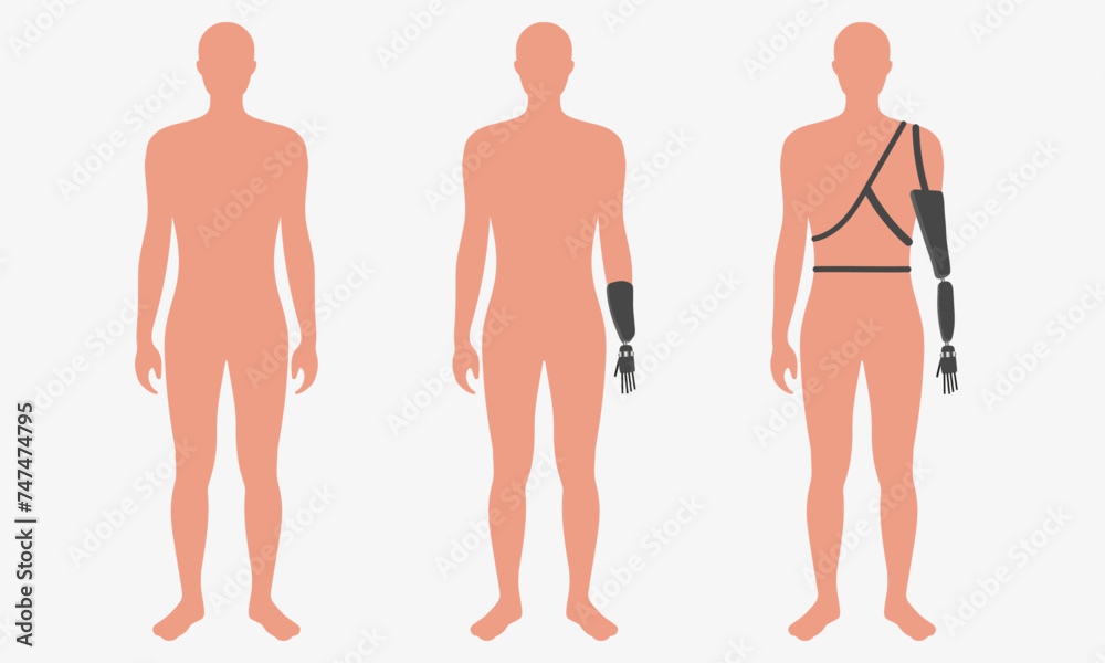 Disabled man wearing innovative exoskeleton