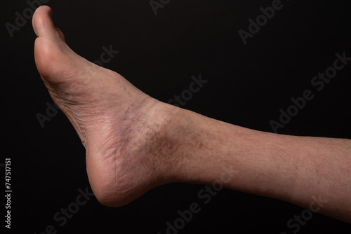 Disabled  legs/feet with high instep and varicose veins photo