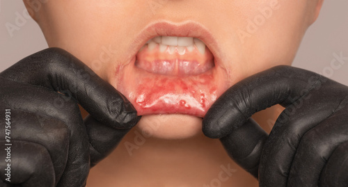 Foto Inflammatory process on the oral mucosa