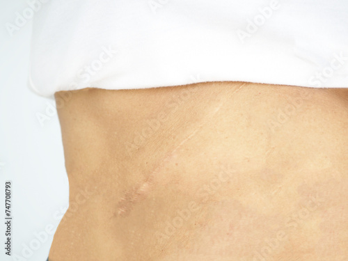Scars on woman's stomach after gallstone surgery. Medical and health concept. photo