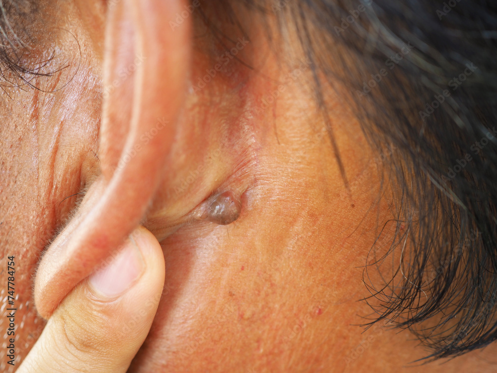 Man pointed to sebaceous cysts on his neck, formed by sebaceous glands. Oils called sebum and laser skin treatments or flea biopsies health concept. closeup photo, blurred. Man pointed to sebaceous cysts on his neck, formed by sebaceous glands. Oils called sebum and laser skin treatments or flea biopsies health concept. closeup photo, blurred.
