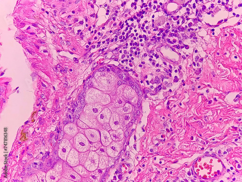 Miscellaneous tissue in ovarian teratoma 40x photo