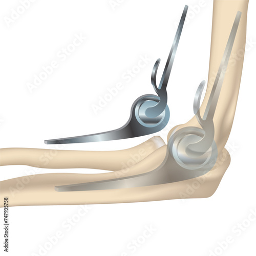 Endoprosthetics of the elbow joint, humeral head. The concept of treating ochteochondrosis, osteoporosis and injuries with metal implants. Medical vector illustration