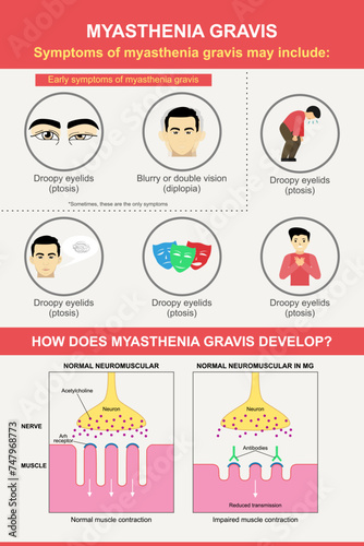 Myasthenia gravis infographic illustration of signs and symptoms