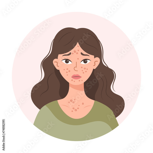 Acne. Unhappy teenage girl with acne and pimples on her face. Irritated facial skin. Illustration, vector