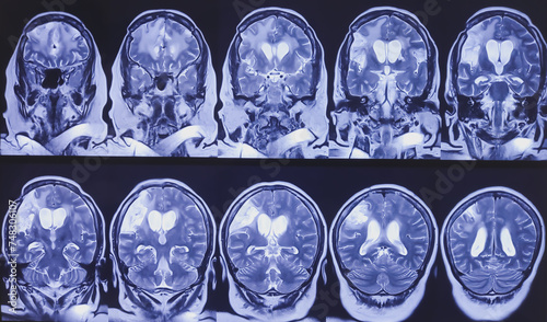 MRI (Magnetic Resonance Imaging) of brain and MRA. Brain showing encephalomalacia with extensive gliosis and lesion in left frontal convexity. Diffuse T2WI FLAIR hyper intensity. Cerebral atrophy.