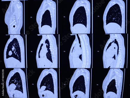 Multi slice HRCT scan of chest showing normal study, normal appearance of the lungs, parenchyma, pulmonary vasculature, mediastinal structures, no adenopathy, no pleural effusion, no abnormality. photo