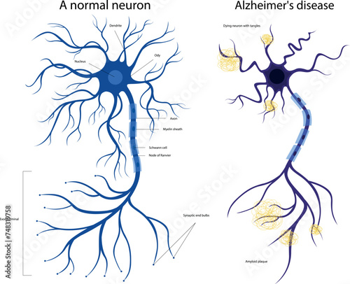 The structure of a sick and healthy neuron. Damaged neuron. Alzheimers disease. Brain disease dementia, memory disorders. A neuron in Alzheimer's disease