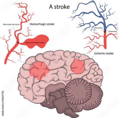 Vector illustration of a stroke. Hemorrhagic stroke and ischemic stroke of the brain.