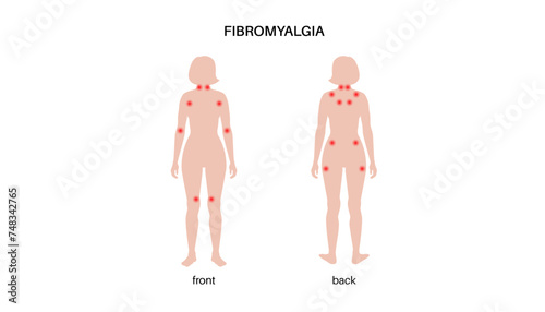 Fibromyalgia medical poster