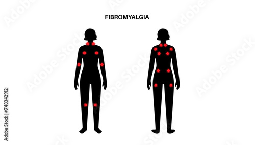 Fibromyalgia medical poster