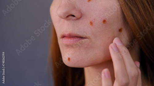 Woman with burns on her face after removing moles cosmetic aesthetic skin procedure. footage