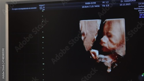 Ultrasound 4D of the child in the womb. Modern medical equipment, medicine and healthcare concept. photo