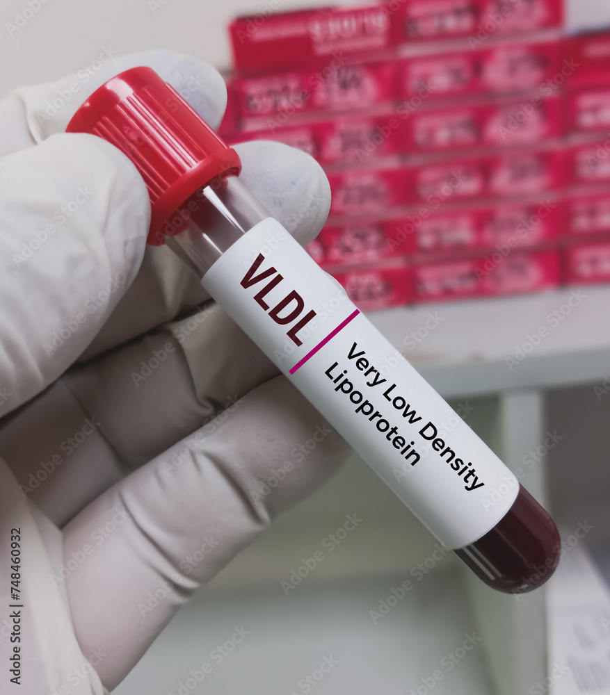 Blood sample for VLDL (Very Low Density Lipoprotein) test, helps assess