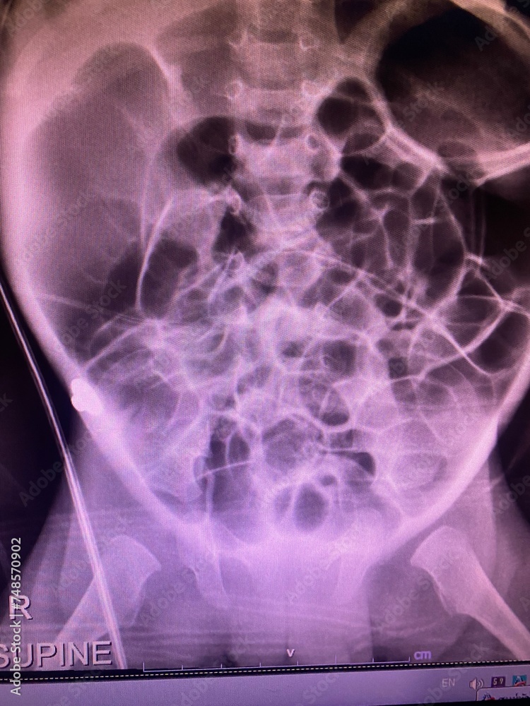 Film. X-ray show generalized bowel dilate with double bowel wall ...