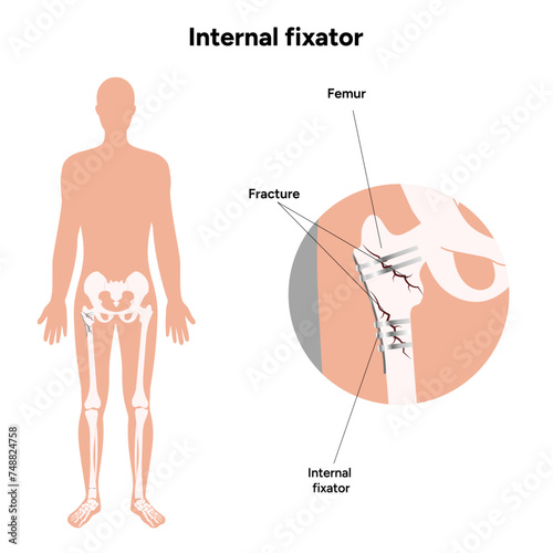 Internal Fixation for Fractures bone