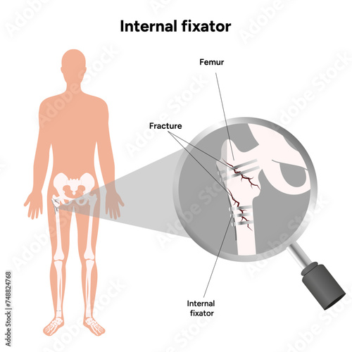 Internal Fixation for Fractures bone zoom