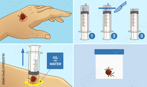 Tick bite. How to remove the tick.  Healthcare illustration. Medical infographic. Vector illustration.
