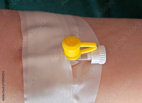 catheter for blood test. catheter in a vein in a patient. Image of a hand with a catheter for blood test from a vein. Patient with intravenous cannula in arm. close up