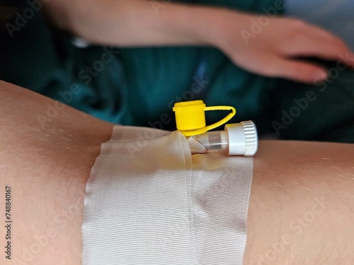 catheter for blood test. catheter in a vein in a patient. Image of a hand with a catheter for blood test from a vein. Patient with intravenous cannula in arm. close up