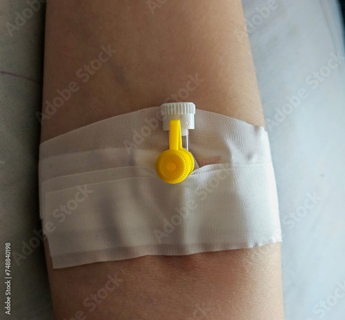 catheter for blood test. catheter in a vein in a patient. Image of a hand with a catheter for blood test from a vein. Patient with intravenous cannula in arm. close up