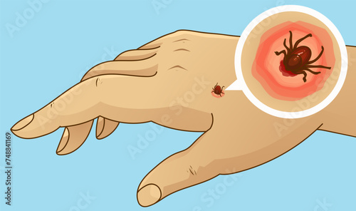 Tick ​​bite. Tick on a human's hand. Healthcare illustration. Vector illustration.