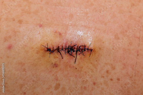 Double sutured scar of abscess surgery on a back photo