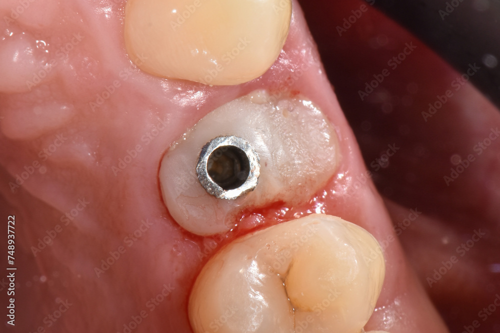 Fototapeta premium A close-up view inside person's mouth during dental examination