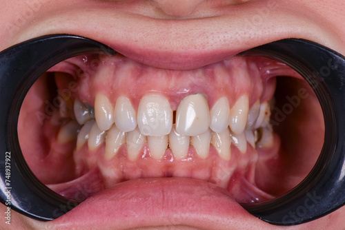 Frontal occlusal view in macrophotography  photo