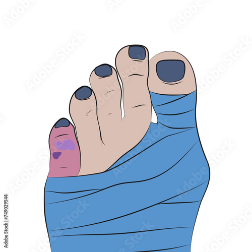 Vector bandaged foot, toes with bruises.