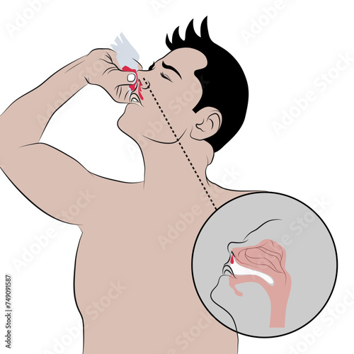 Nosebleeds, nosebleeds usually in one nostril.