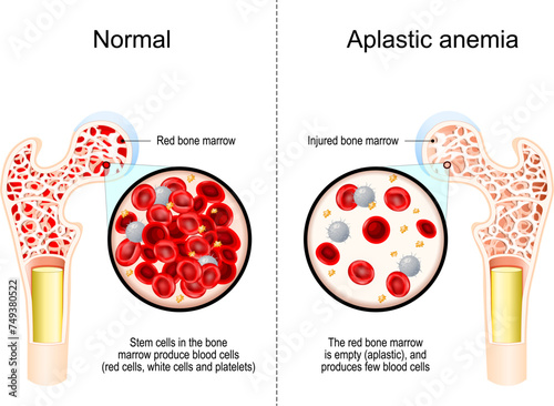 Aplastic anemia photo