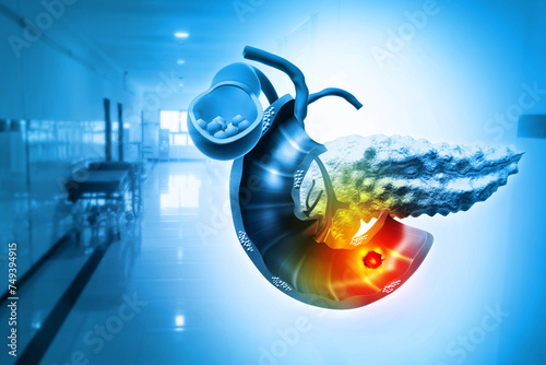 Pancreatic cancer or tumor. 3d illustration