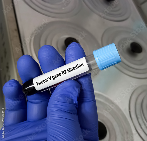 Blood sample for Factor V gene R2 test, a mutation of clotting factors in the blood which may increase the chance of developing abnormal blood clots. PT G20210A mutation.
