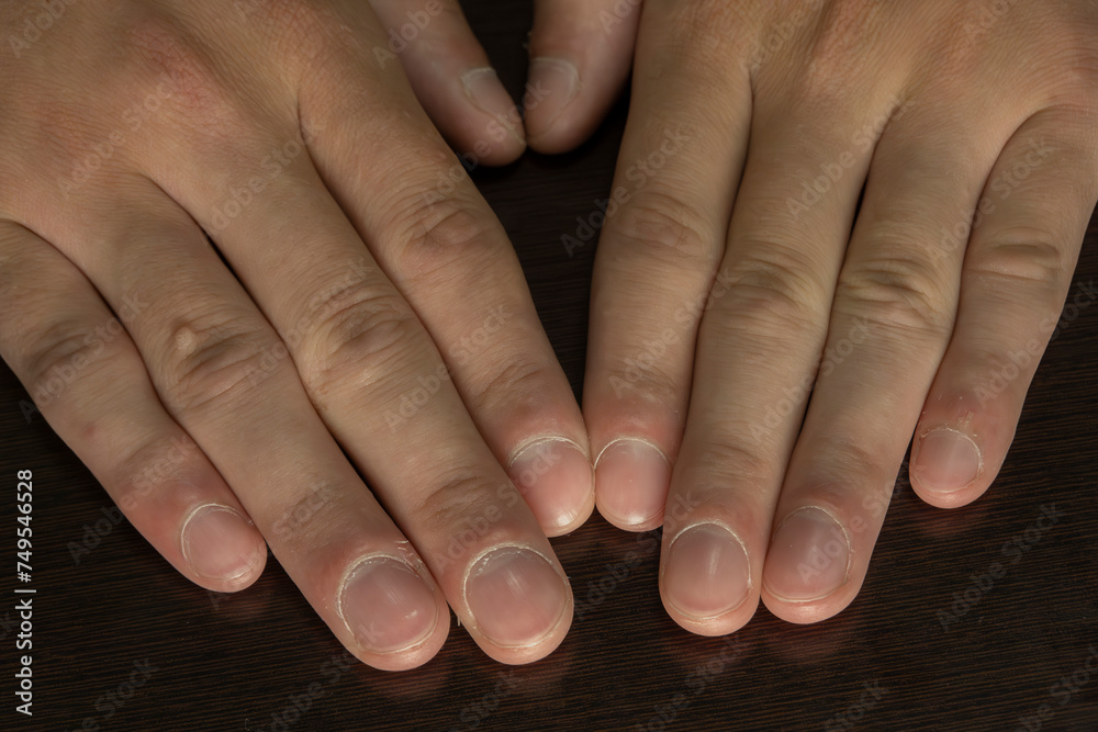 Young male with nail clubbing. Medical themes