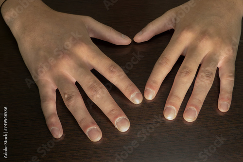Fotografija Young male with nail clubbing. Medical themes