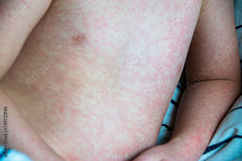 Viral disease. Measles rash on the body of the child. Allergy photo