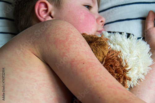 Viral disease. Measles rash on the body of the child. Allergy