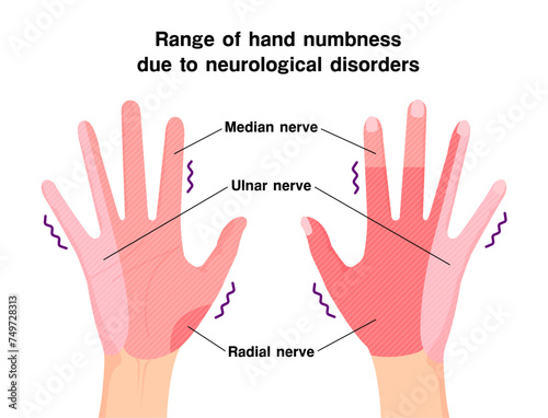 Range of hand numbness due to neurological disorders