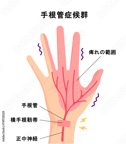 手根管症候群の原因と痺れの範囲 ベクターイラスト