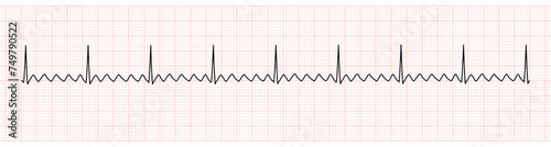 EKG Monitor Showing  Atrial Flutter