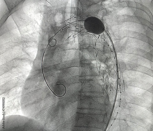 Stent graft balloon catheter was inflated after stent graft deployed at descending aorta during Thoracic endovascular aortic repair (TEVAR).