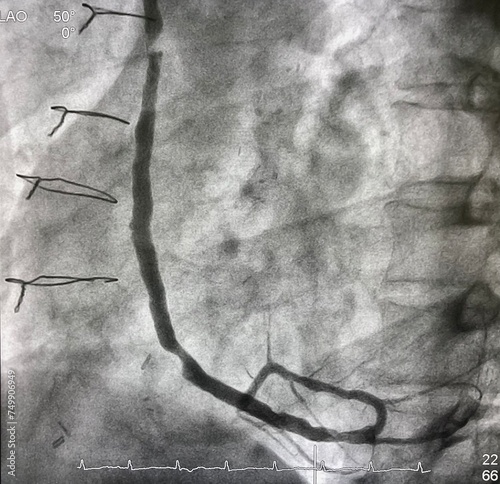 coronary angiogram showed saphenous vein graft (SVG) was stenosis after coronary artery bypass graft  (CABG) surgery.