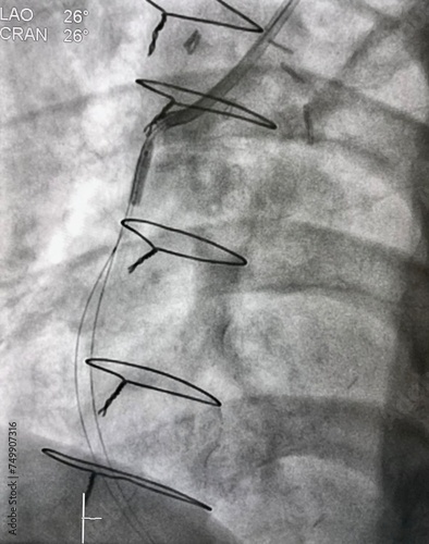 coronary angiogram showed saphenous vein graft (SVG) with balloon was inflated during percutaneous coronary intervention (PCI).