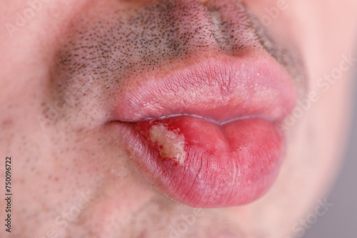 Herpes virus and infection treatment. Macro Men lips. Cold sore on the lip of a middle aged male. 
