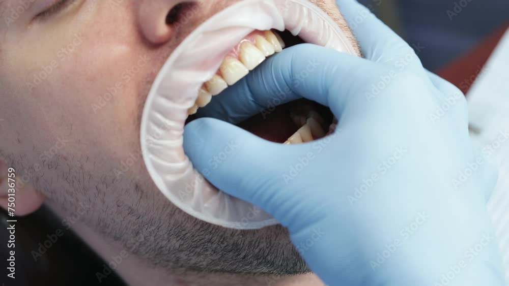 Unscrewing a healing abutment with a torque wrench, often referred to as a healing cap or