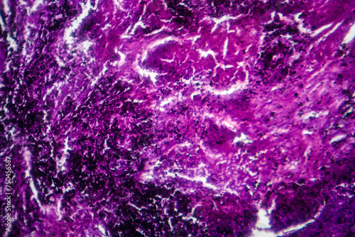 Photomicrograph of lung tissue with silicosis pathology under a microscope, revealing silica particle accumulation in alveoli and fibrosis.