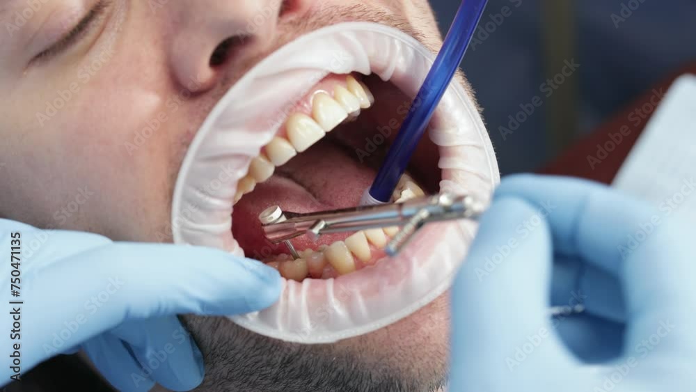 Tightening the healing abutment with a torque wrench, often referred to as a healing cap or