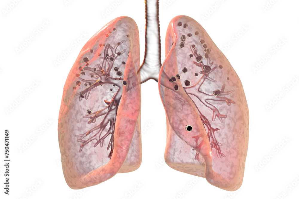 Lungs affected by silicosis, 3D illustration Lungs affected by silicosis, 3D illustration