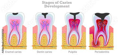 Caries stages development. Tooth decay enamel, dentin caries, pulpitis, periodontitis chart. Medical , dental pain. Illustration vector photo